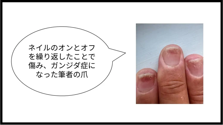 ネイルのオンとオフを繰り返したことでカンジダ症になった筆者の爪の写真