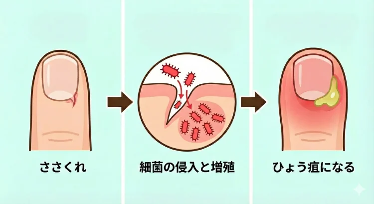ささくれから細菌感染を起こし、ひょう疽になる