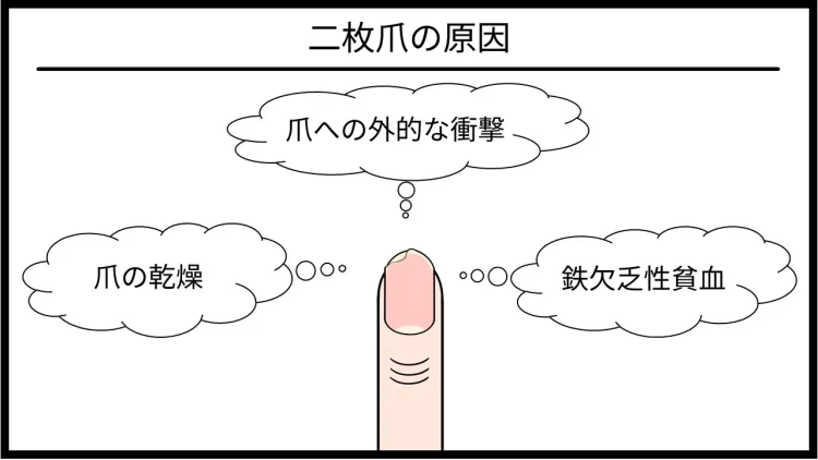 二枚爪の原因は爪の乾燥と爪への外的な衝撃と鉄欠乏性貧血の3点です。